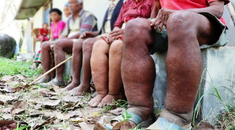 तराईका जिल्लामा हात्तीपाइले रोगको विरुद्धको औषधि खुवाउने सरकारको तयारी 