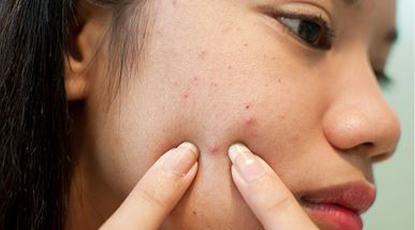 डण्डीफोर कसरी आउँछ ? र डण्डीफोरको दाग कसरी हटाउन सकिन्छ ?